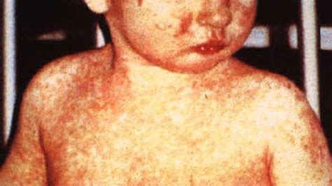 Measles Outbreak In Washington Anti Vaccine Hot Spot What To Know