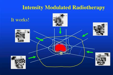ppt intensity modulated radiotherapy and inverse planning powerpoint presentation id 4010384