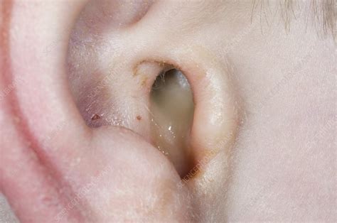 Otitis Media With Perforated Eardrum Stock Image C0168169