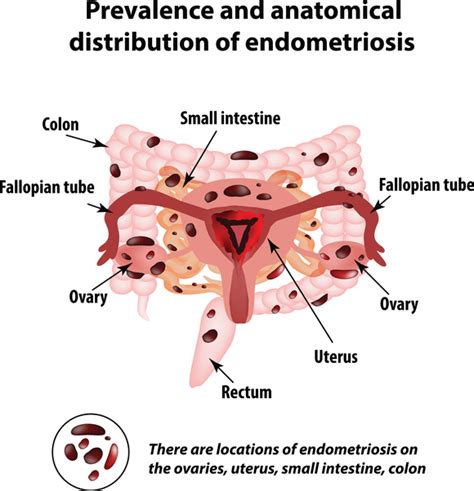 Endometriosis And Diet What You Can Do About It In 2019 Diet Vs Disease