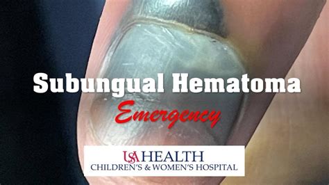 Subungual Hematoma Emergency And Trephination Procedure Youtube