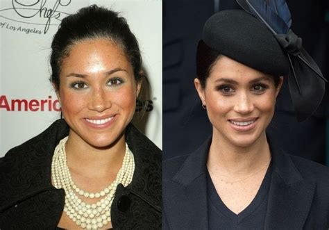 Meghan Markle Accused Of Having Had Cosmetic Surgery Celebrity