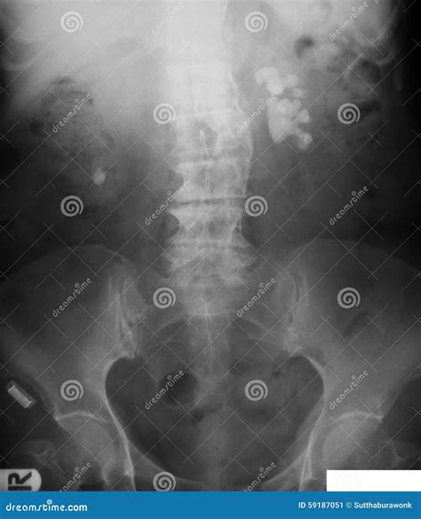 X Ray Image Of Plan Kubkidneyureter And Bladder Supine View Stock