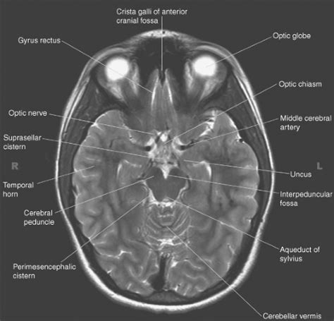 Introduction To Brain Imaging Radiology Key