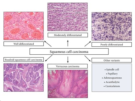 Histologic Subtypes Of Oral Squamous Cell Carcinoma Download Scientific Diagram