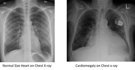 Cardiomegaly Chest Xray