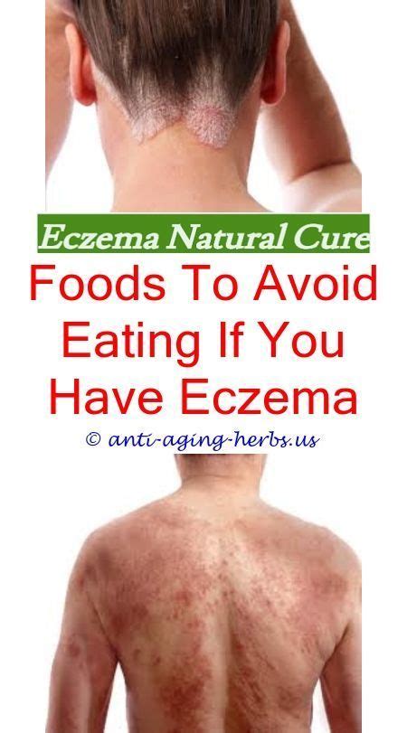 Natural Remedies For Eczema Eczema Psychological Causes What Works