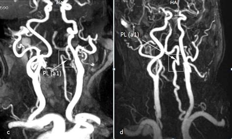 Mr Angiography Of Head And Neck The Third Segment Of The Left Va Is