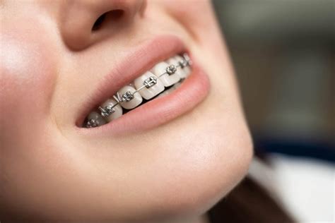 Clear Braces Vs Metal Braces Koen Orthodontics