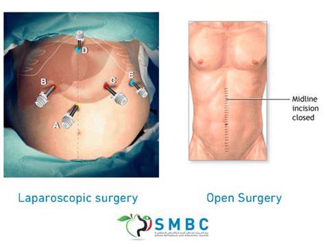Laparoscopy Or Open Which Is Better SMBC