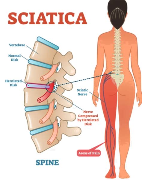 What Is Sciatica Causes And Treatment Options