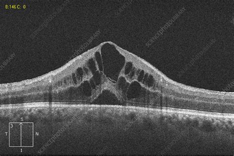 Cystoid Macular Edema Stock Image C Science Photo Library