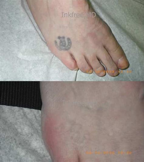 Does Laser Tattoo Removal Leave A Scar Inkfree Md