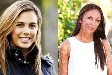Turia Pitt Story Everything About Her Impressive Recovery From Burns