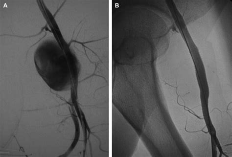 A And B Femoral Angiogram Shows The Large Left Common Femoral Artery