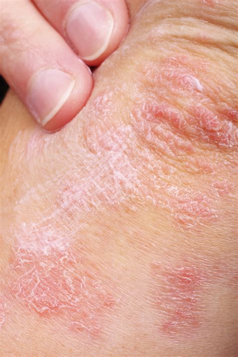 Dry Skin Signs Causes And Treatment Options