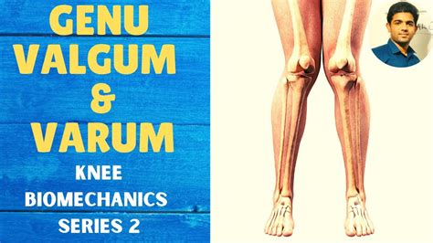 Genu Valgum And Genu Varum Knee Complex Biomechanics Youtube