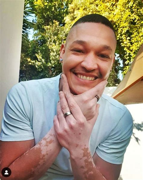 Top 5 Mzansi Celebrities Living With Vitiligo In South Africa