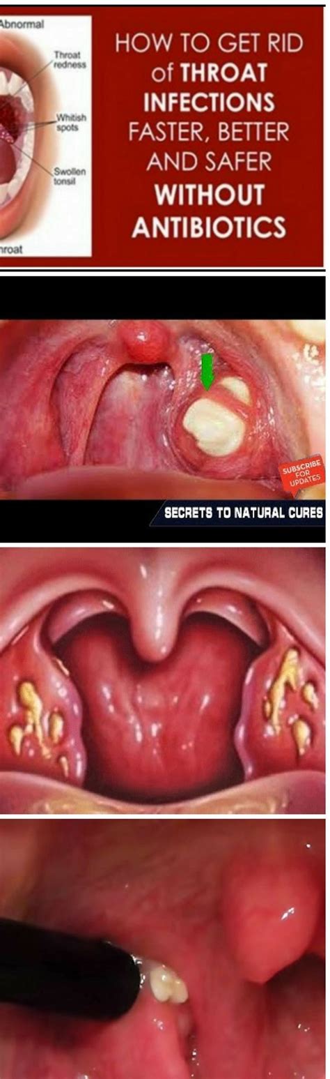 Get Rid Of Tonsillitis And Sore Throat Naturally Tonsils Gezondheidstips
