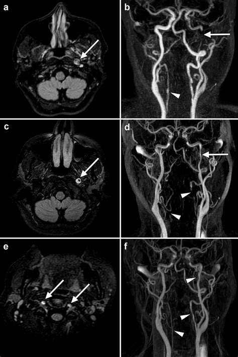 Mri Sequences Showing The Progression Of Cervical Artery Dissection In Download Scientific