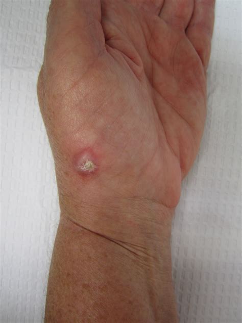 Lumps Bumps And Cysts In The Hand John Erickson Md
