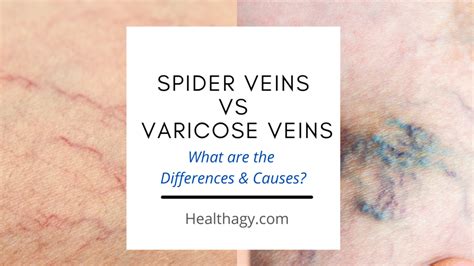 Spider Veins Vs Varicose Veins What Are The Differences And Causes Healthagy