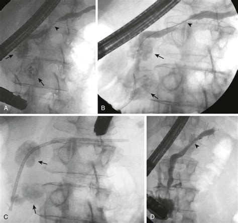 Endoscopic Retrograde Cholangiopancreatography Radiology Key