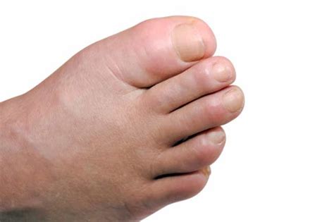 How To Treat Diabetes Swollen Feet Meaning How To Cure Diabetes On Your Own Pathophysiology Of