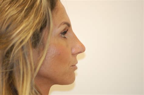 Rhinoplasty Richmond Virginia World Class Nose Job And Nasal Surgery
