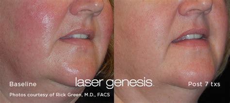 Laser Genesis Imami Skin And Cosmetic Center