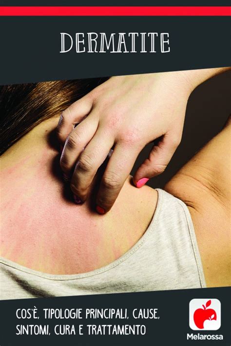 Dermatite cosè tipologie principali cause sintomi cura e trattamento