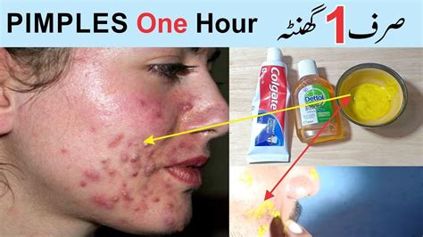 Remove Pimples Fast Naturally How To Get Rid Of Acne Around Mouth
