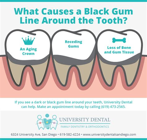 What Causes A Black Gum Line Around The Tooth University Dental San