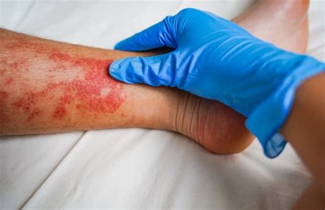 Key Differences Between Varicose Eczema Vs Other Eczemas Vein Solutions