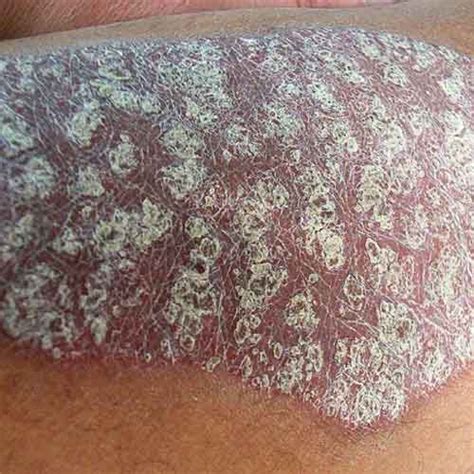 Pictures Of Psoriasis On Elbows Trunk And More