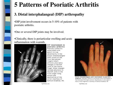 Ppt Psoriatic Arthritis Powerpoint Presentation Free Download Id71148