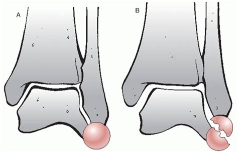 Ankle Fractures Teachme Orthopedics