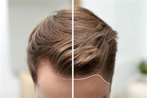Haartransplantation Bei Blonden Haaren Tophairclinic