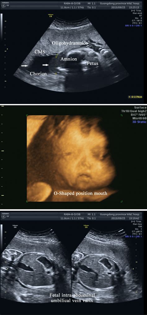 Ultrasonography Examination Of The Second Fetus At 26⁺¹ Weeks Of