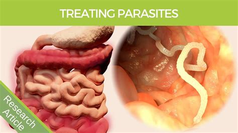 Human Intestinal Parasite Treatment Explained Youtube