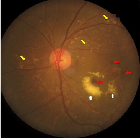 Fundus Findings Of Most Patients In The Study Notes Red Arrows