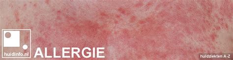Allergie Duidelijk Uitgelegd Huidinfonl Info Van De Dermatoloog