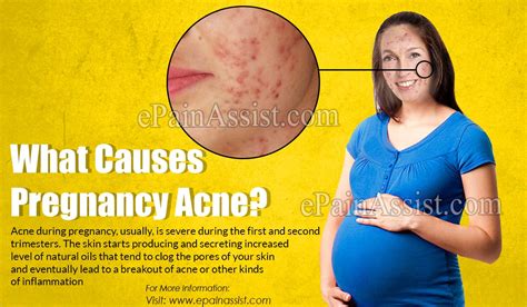 What Causes Pregnancy Acne And How To Deal With Acne During Pregnancy