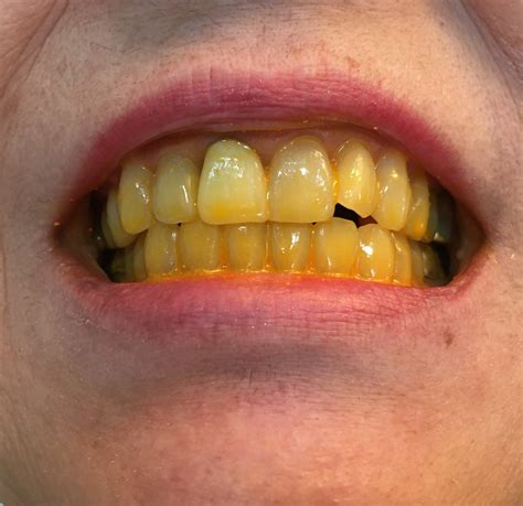 Yellow For Yellowing Teeth By Auntyby Aunty