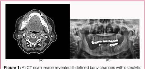 Figure 1 From A Rare Case Of 66 Year Old Woman With Right Lumpy Jaw