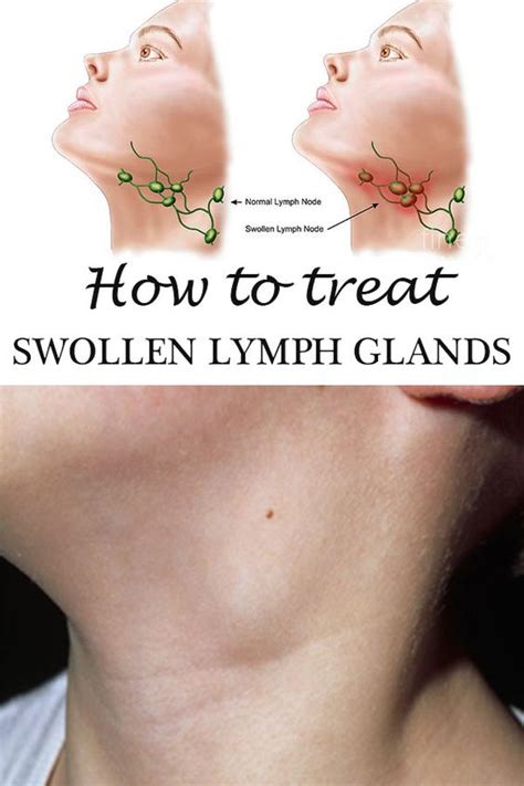 Swollen Occipital Lymph Node Sore Throat Somesolid