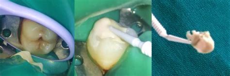 Stamp Technique To Restore Occlusal Anatomy Of The Posterior Tooth A