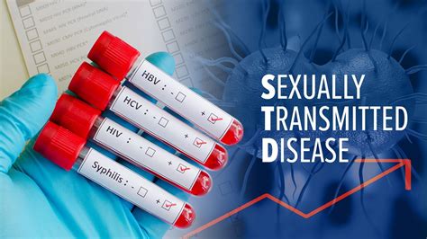 Sexually Transmitted Diseases In San Diego County Hit 20 Year High Stds At 30 Year High In