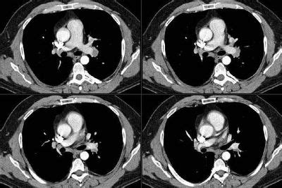 Pulmonary Roundtable Abnormal CT Scan