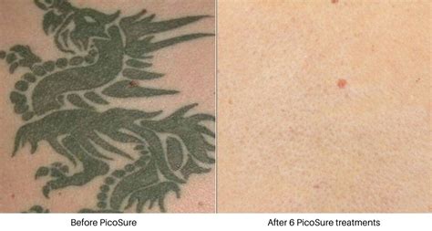 Laser Tattoo Removal With The Picosure